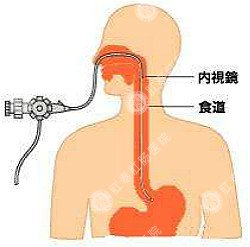 便血后用什么检查办法？根据症状而定！